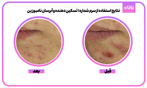 سرم شماره 1 تسکین دهنده و آبرسان نامبوزین