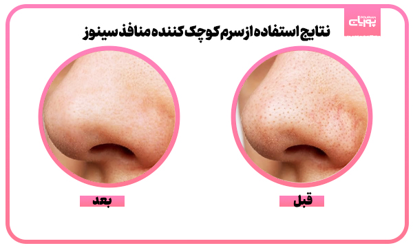 سرم کوچک کننده منافذ سینوز