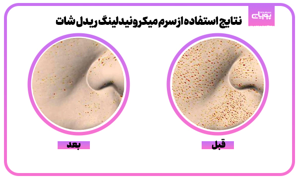 سرم میکرونیدلینگ ریدل شات